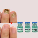AdiExpress nail repair growth serum, nail fungus treatment medicine, nail repair serum
