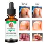 Fezora Repair Nail Serum Nail Serum For Growth and Repair Nail Fungus Nail Cream For Fungal Infection Broken Nail 30 ML [Pack Of 1]