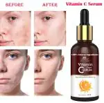 Intimify Vitamin C serum for Pigmentation, Dark Spots, Patches, Scars, Age Spots, Fine lines