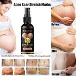 Kuraiy Best Actives Stretch Marks Removal Cream Oil for Women in During After Pregnancy No Paraben No Sulphate No Added Colors or Fragrance No Mineral Oil Cellulite Remover Massage Slimming Oil Remove