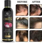 GLOW OCEAN - GLOW EVERYDAY Onion oil For Hair Fall Control, Hair Growth & Hair Regrowth-Control Dandruff Hair Oil (100 ml)