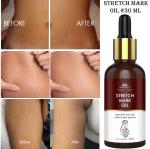 Intimify Stretch Mark Oil Removes Stretch Marks & Scars, Stretchy Skin, Promotes Skin Cell