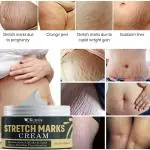 KURAIY Pure new Effectively Repair Stretch Marks Removal Remover Plant Natural Heal Pregnancy Breast Hip Legs Stretch Mark Cream
