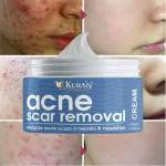 KURAIY Natural Acne Removal Face Cream Herbal Anti Acne Gel Pore Shrink Fade Face Back Acne Mark Scar Tea Tree Serum Acne Treatment Skin Care