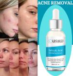 LUCACCI Pore Minimizing Face Serum, Oil Control Serum, Spot Treatment Serum, Skin Renewal Serum, Blackhead Clearing Serum [ 30 ML / PACKOF 1]