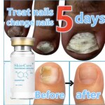 AdiExpress Nail serum for nail growth repair Nail cuticle remover Nail filer set