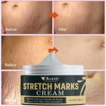 KURAIY New Scar Repair Cream Acne Scars Remove Pregnant Women Skin Care Stretch Marks Removal Maternity Fat Striae Gravidarum Treatment 50g