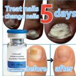 AdiExpress Nail cuticle oil Nail cuticle cream nail fungal infection