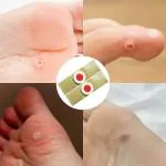 DP FASHION 20 Pcs Corn Remover Pads,Wart Remover,Foot Corn Remover Patch,Foot Care Corn Caps,Corn Removal Treatment Relieve Corn Pain and Foot Care,Soften Skin Cutting Sticker Toe Protector,Remove Corns,Calluses