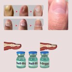 AdiExpress nail fungus treatment, nail repair serum, nail care serum, nail growth oil fast