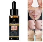 Anti Acne Face Serum - Natural Neem Leaf Oil, Tea Tree Oil, Caviar Lime Fruit Extract - Spot Therapy - No Parabens, Silicones & Fragrance - 30 mL