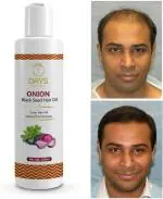 7 Days Red Onion Hair Oil Controls Hair Fall - No Mineral Oil Hair Oil (100 ml)
