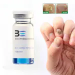 AdiExpress Toenailcare Removal Paronychia Oil Ingrown Toenail Treatment Best Nail Repair Solution Nail Renewal Liquid