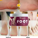 KURAIY Natural Foot corn remover Cream, for dry hard cracked heel skin repair / swelling & pain relief / feet care