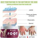 KURAIY 100% Pure Foot corn remover Cream , for dry hard cracked heel skin repair / swelling & pain relief / feet care men and women.