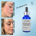 VIKENDI Salicylic Acid Serum for, Acne & Open Pores Reduces Excess Oil