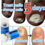 AdiExpress Repair nail fungus Nail fungal Nail cream Nail cuticle oil Nail cuticle cream