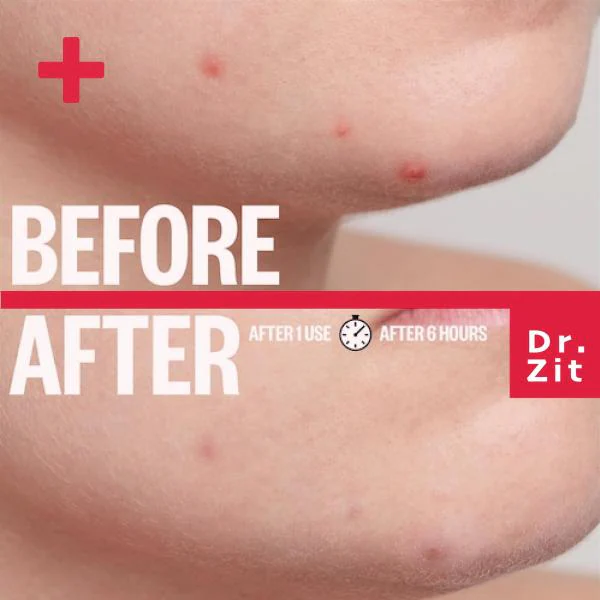 Spot Patch Dr Zit Acne Pimple Patch Hydrocolloid For Blemish Patches