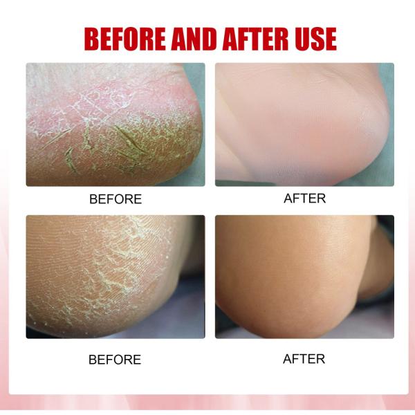 HOW TO REMOVE DEAD SKIN CELLS FROM YOUR FEET IN MINUTES Self Care