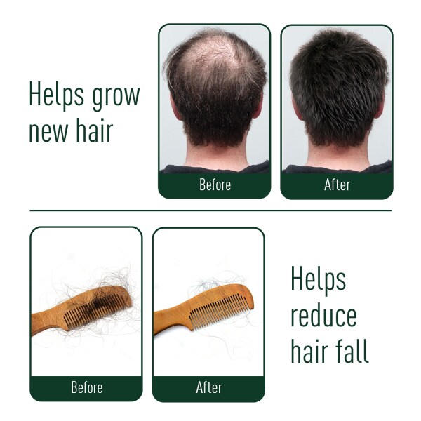 Neem Ayu Expert Anti Hair Fall Kit for Hair Growth| 200ml Shampoo, 100ml  Oil, and