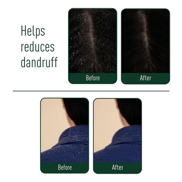 Neem Ayu Ayurvedic Anti Dandruff Hair Oil for Dandruff Free Hair and Scalp  - JioMart