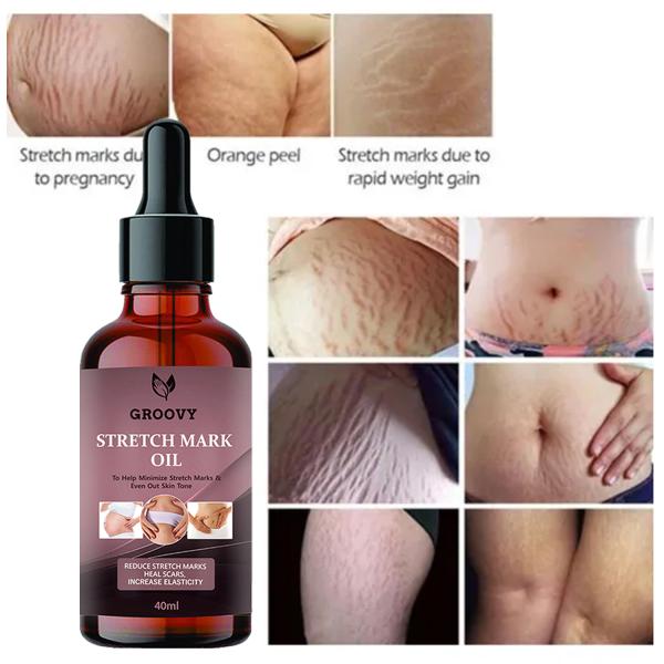 Groovy Stretch Mark Oil with the Goodness of Seabuckthorn Oil, Vitamin