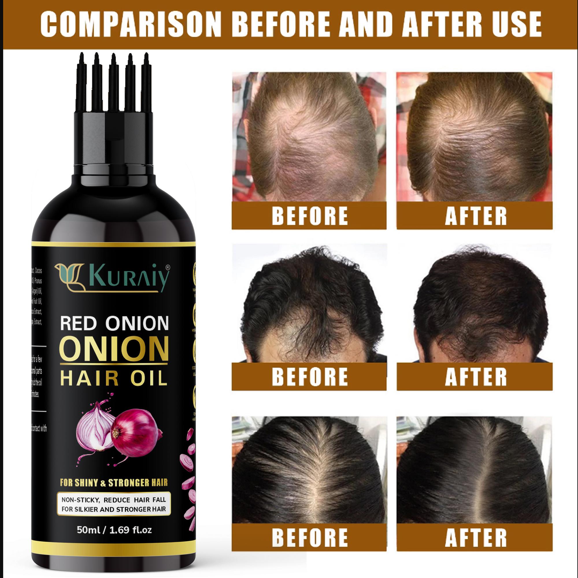 KURAIY Red ONION OIL Fast Powerful Hair Growth Essence Hair Loss Products  Essential Oil Treatment Preventing Hair Loss Hair Care Products for men &  women - JioMart