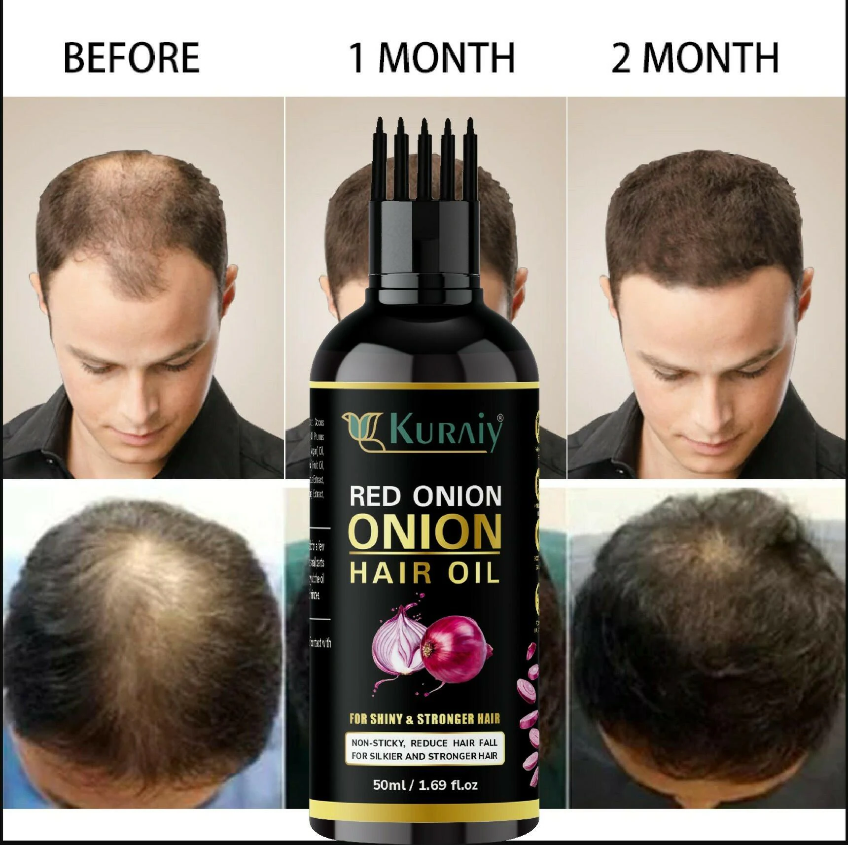 KURAIY 100% Red Onion Oil Hair Growing Red Onion Oil, which increases the  collagen tissue level, provides rapid growth, and ends hair loss. (50 ml )  & (MEN & WOMEN) - JioMart
