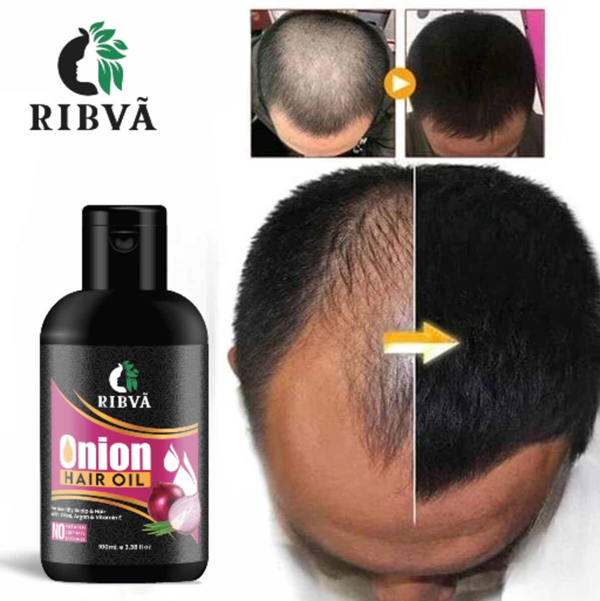 RIBVA Onion Hair Oil for Hair Regrowth, Dandruff Control Hair Oil (100 ml)  - JioMart